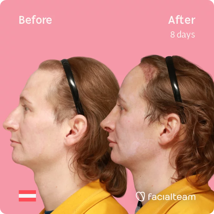 Square Side image of FFS patient Karina showing the results before and after facial feminization surgery with Facialteam consisting of tracheal shave, forehead with SHT, rhinoplasty, jaw feminization surgery.