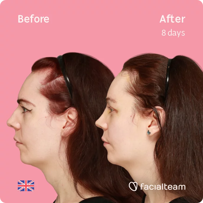Square Left Side image of FFS patient Amber showing the results before and after facial feminization surgery with Facialteam consisting of tracheal shave, forehead with SHT, rhinoplasty feminization surgery.