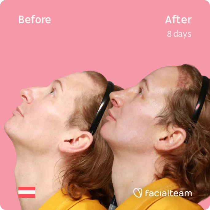Square side image of FFS patient Karina looking up showing the results before and after facial feminization surgery with Facialteam consisting of tracheal shave, forehead with SHT, rhinoplasty, jaw feminization surgery.