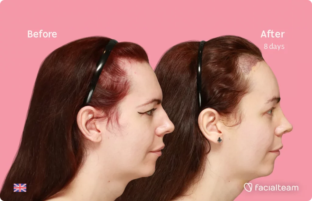 Right side image of FFS patient Amber showing the results before and after facial feminization surgery with Facialteam consisting of tracheal shave, forehead with SHT, rhinoplasty feminization surgery.