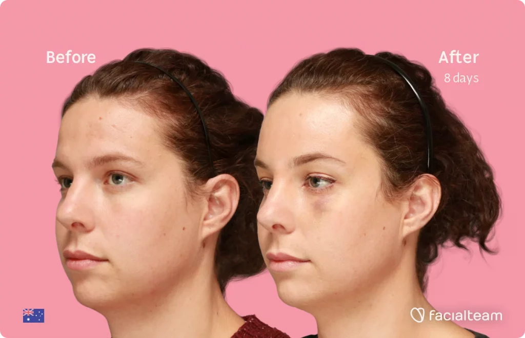 45 degree image of FFS patient Charlie showing the results before and after facial feminization surgery consisting of forehead feminization surgery.