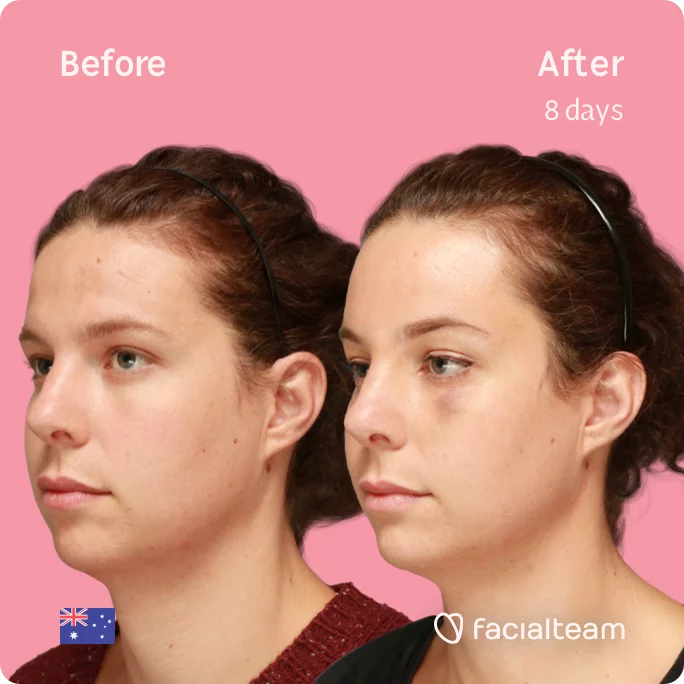 Square 45 degree image of FFS patient Charlie showing the results before and after facial feminization surgery consisting of forehead feminization surgery.