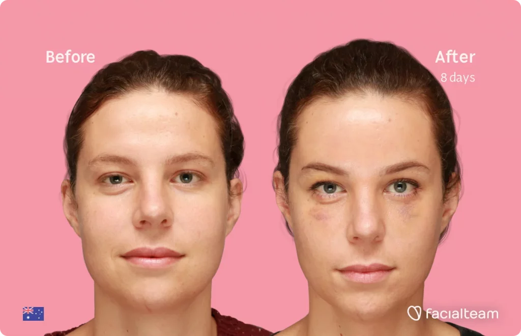 Frontal image of FFS patient Charlie showing the results before and after facial feminization surgery with Facialteam consisting of forehead feminization surgery.
