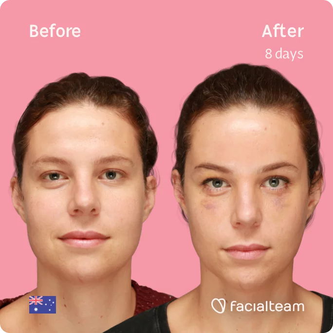 Square frontal image of FFS patient Charlie showing the results before and after facial feminization surgery with Facialteam consisting of forehead feminization surgery.