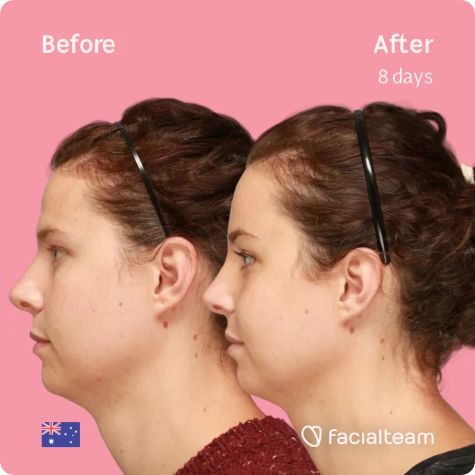 Square Side image of FFS patient Charlie showing the results before and after facial feminization surgery with Facialteam consisting of forehead feminization surgery.