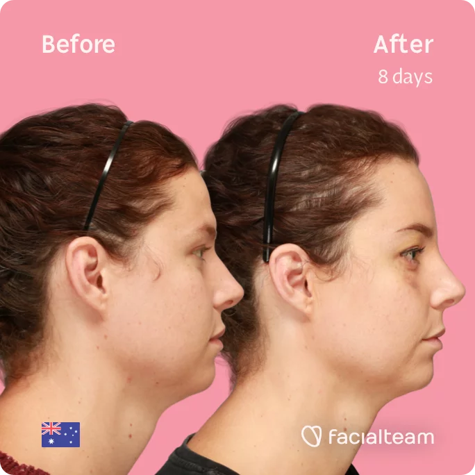 Square right side image of FFS patient Charlie showing the results before and after facial feminization surgery with Facialteam consisting of forehead feminization surgery.
