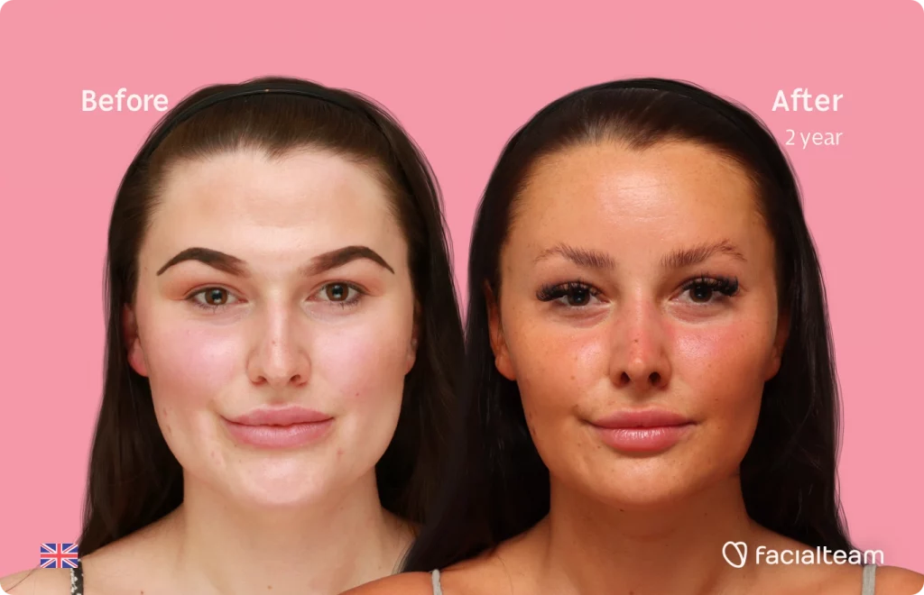 Frontal image of FFS patient Summer showing the results before and after facial feminization surgery with Facialteam consisting of forehead feminization, jaw and chin feminization, and rhinoplasty.