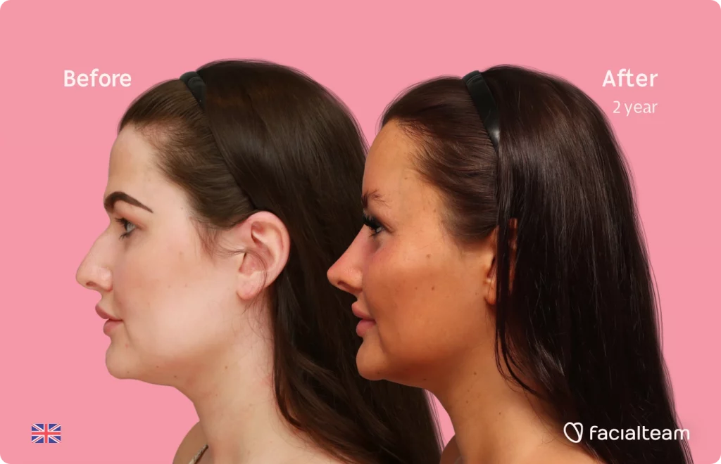 Side image of FFS patient Summer showing the results before and after facial feminization surgery with Facialteam consisting of forehead feminization, jaw and chin feminization, and rhinoplasty.