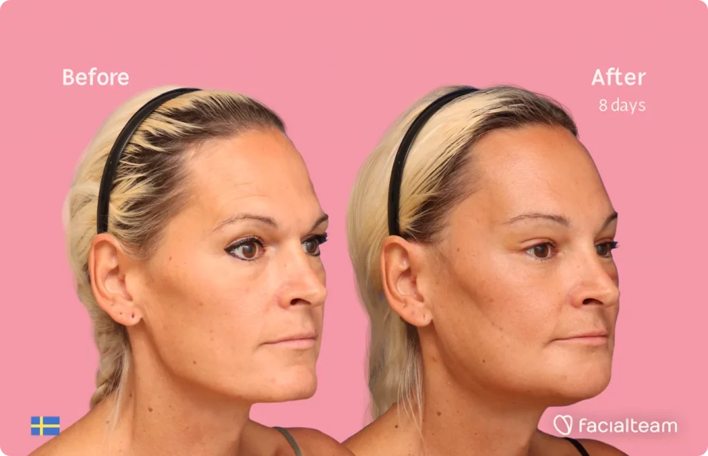 45 degree image of FFS patient Julia showing the results before and after facial feminization surgery consisting of forehead, jaw, chin feminization surgery.