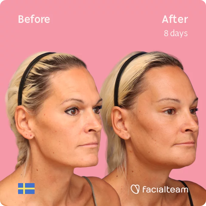 Square 45 degree image of FFS patient Julia showing the results before and after facial feminization surgery consisting of forehead, jaw, chin feminization surgery.