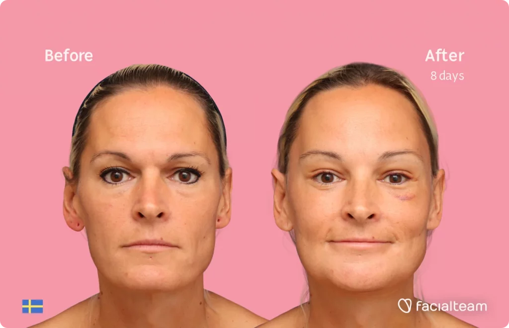 Frontal image of FFS patient Julia showing the results before and after facial feminization surgery with Facialteam consisting of forehead, jaw, chin feminization surgery.