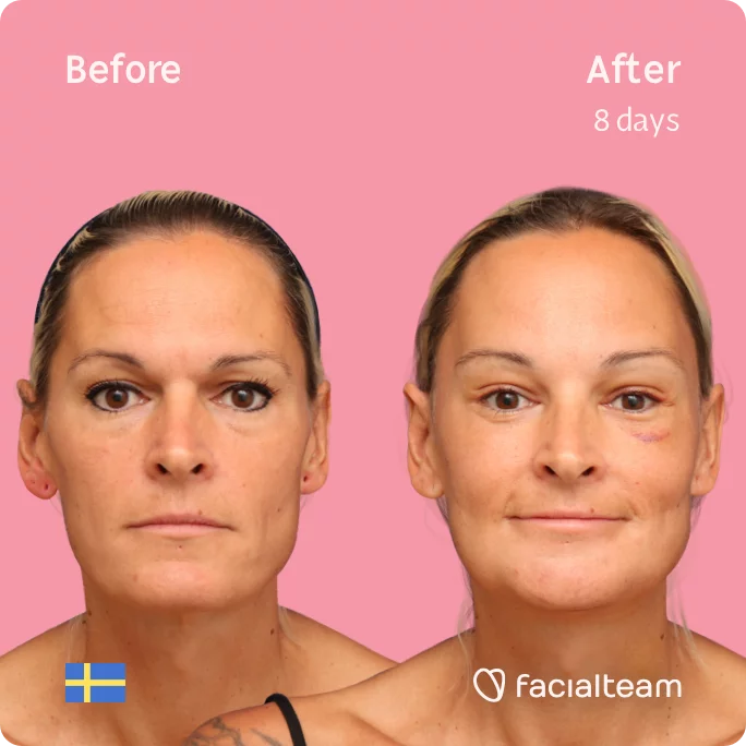 Square frontal image of FFS patient Julia showing the results before and after facial feminization surgery with Facialteam consisting of forehead, jaw, chin feminization surgery.