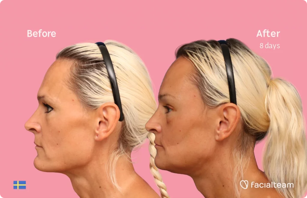 Left side image of FFS patient Julia showing the results before and after facial feminization surgery with Facialteam consisting of forehead, jaw, chin feminization surgery.