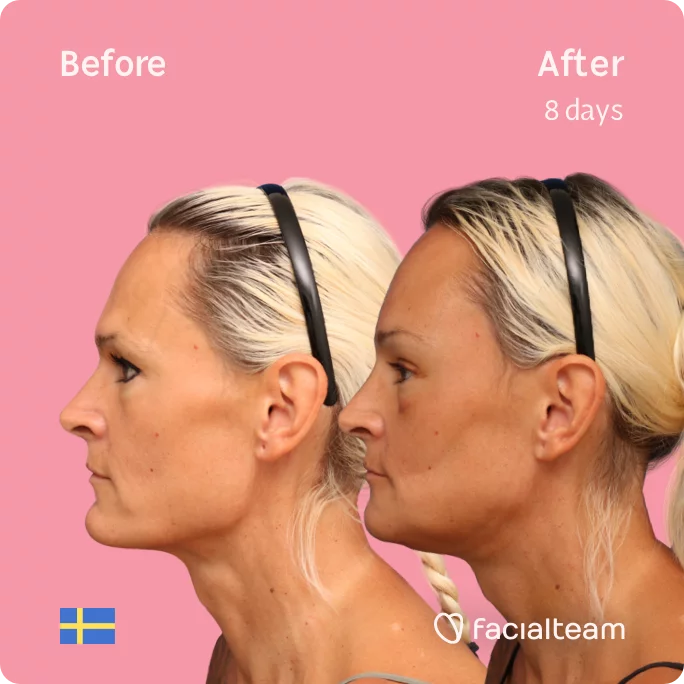 Left square Side image of FFS patient Julia showing the results before and after facial feminization surgery with Facialteam consisting of forehead, jaw, chin feminization surgery.
