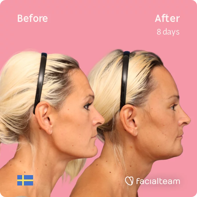 Square Side image of FFS patient Julia showing the results before and after facial feminization surgery with Facialteam consisting of forehead, jaw, chin feminization surgery.
