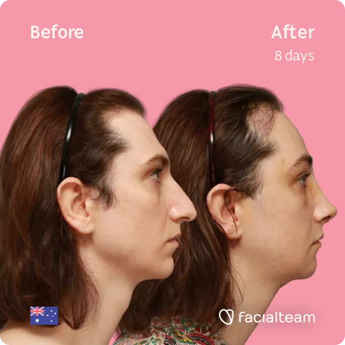 Square Side image of FFS patient Maddison showing the results before and after facial feminization surgery with Facialteam consisting of tracheal shave, forehead with SHT, rhinoplasty, jaw, chin feminization surgery.