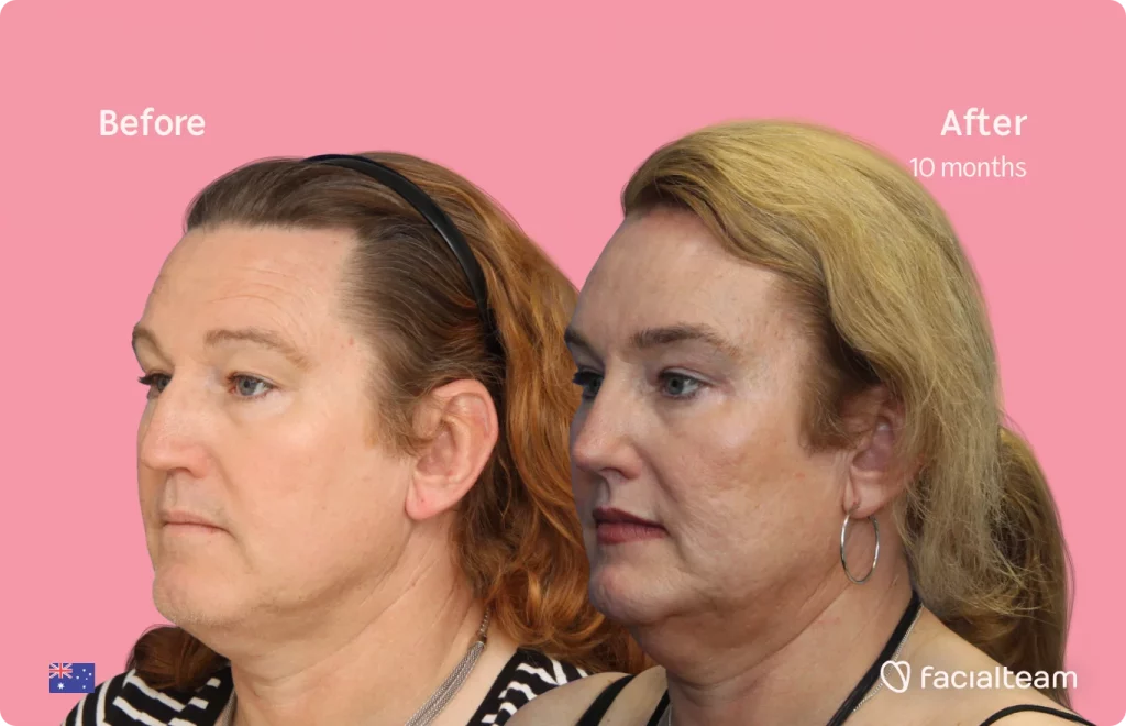Left 45 degree image of FFS patient Vanessa showing the results before and after facial feminization surgery consisting of forehead, jaw, chin, rhinoplasty feminization surgery.