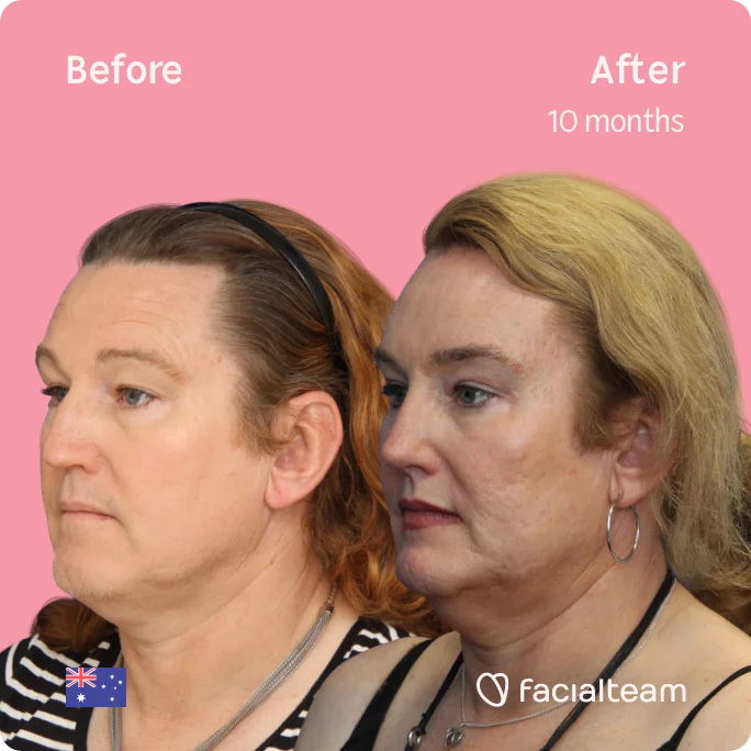 Left square 45 degree image of FFS patient Vanessa showing the results before and after facial feminization surgery consisting of forehead, jaw, chin, rhinoplasty feminization surgery.
