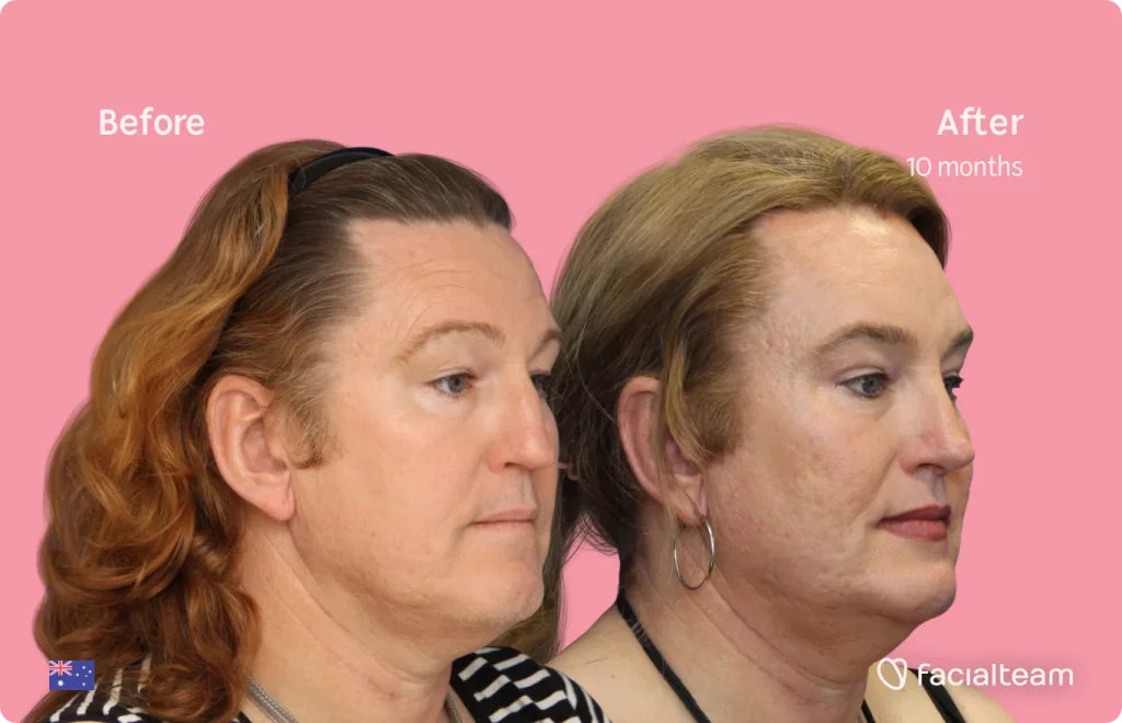 45 degree image of FFS patient Vanessa showing the results before and after facial feminization surgery consisting of forehead, jaw, chin, rhinoplasty feminization surgery.