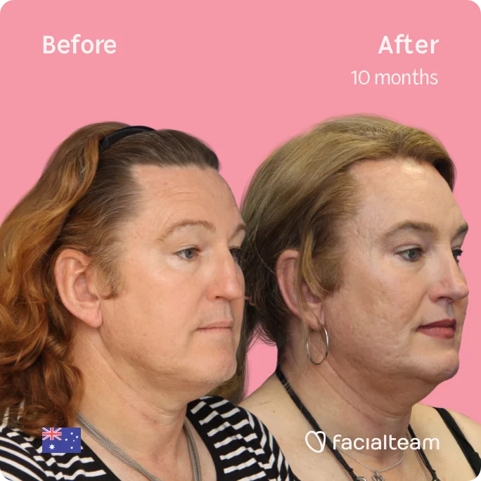 Square 45 degree image of FFS patient Vanessa showing the results before and after facial feminization surgery consisting of forehead, jaw, chin, rhinoplasty feminization surgery.