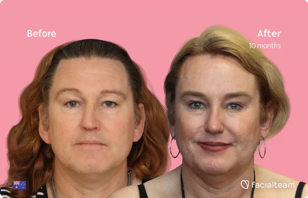 Frontal image of FFS patient Vanessa showing the results before and after facial feminization surgery with Facialteam consisting of forehead, jaw, chin, rhinoplasty feminization surgery.