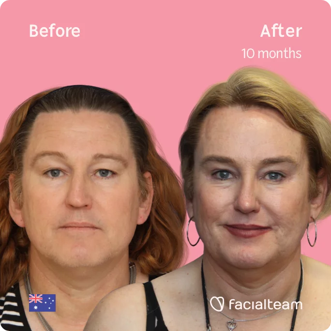 Square frontal image of FFS patient Vanessa showing the results before and after facial feminization surgery with Facialteam consisting of forehead, jaw, chin, rhinoplasty feminization surgery.