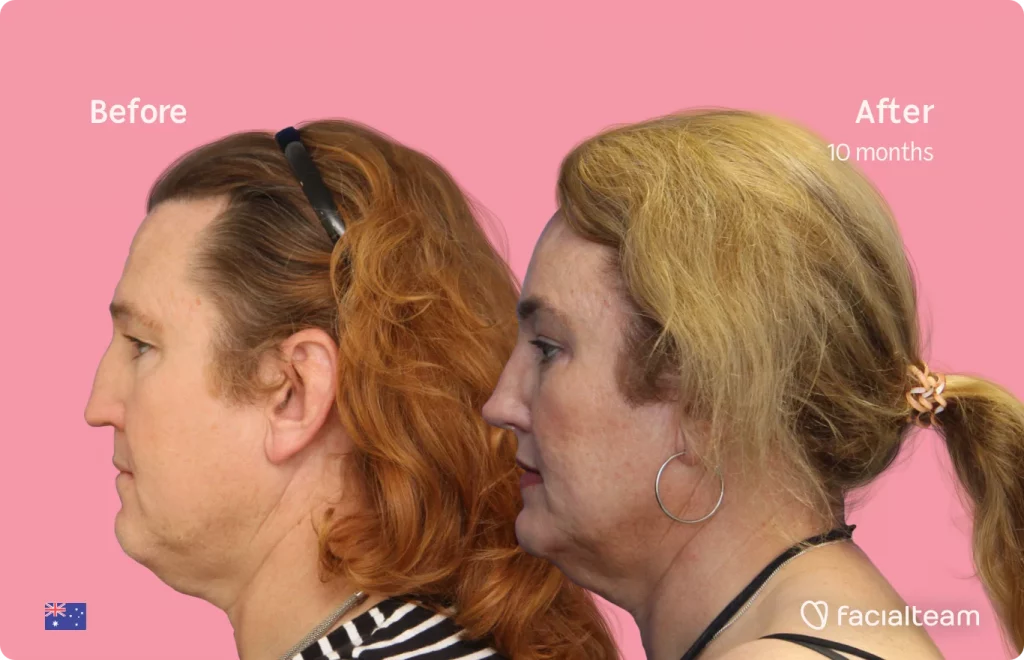Side image of FFS patient Vanessa showing the results before and after facial feminization surgery with Facialteam consisting of forehead, jaw, chin, rhinoplasty feminization surgery.