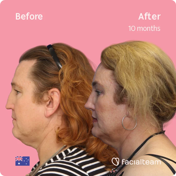 Square Side image of FFS patient Vanessa showing the results before and after facial feminization surgery with Facialteam consisting of forehead, jaw, chin, rhinoplasty feminization surgery.