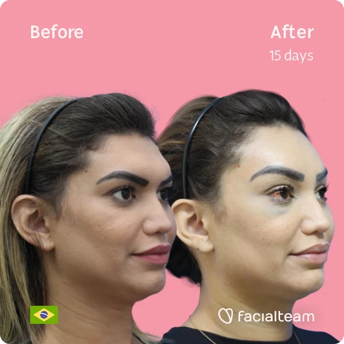 Square 45 degree image of FFS patient Pamela showing the results before and after facial feminization surgery consisting of forehead feminization surgery.