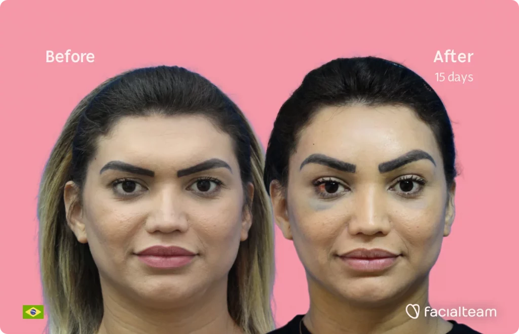 Frontal image of FFS patient Pamela showing the results before and after facial feminization surgery with Facialteam consisting of forehead feminization surgery.