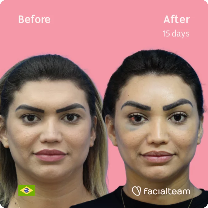 Square frontal image of FFS patient Pamela showing the results before and after facial feminization surgery with Facialteam consisting of forehead feminization surgery.
