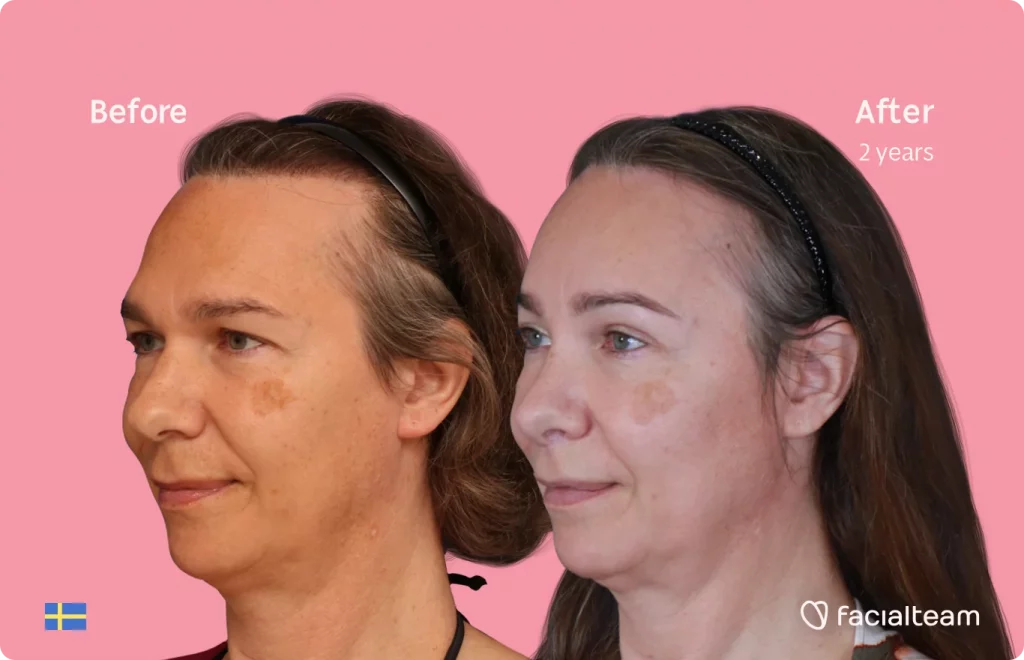 Left side 45 degree image of FFS patient Mia showing the results before and after facial feminization surgery consisting of forehead, rhinoplasty feminization surgery.