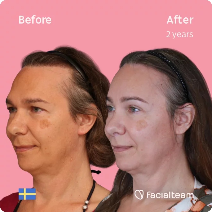 Left side square 45 degree image of FFS patient Mia showing the results before and after facial feminization surgery consisting of forehead, rhinoplasty feminization surgery.
