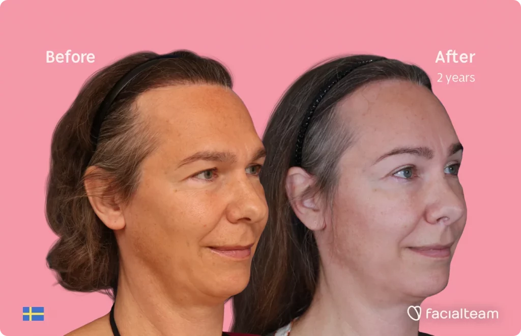 45 degree image of FFS patient Mia showing the results before and after facial feminization surgery consisting of forehead, rhinoplasty feminization surgery.
