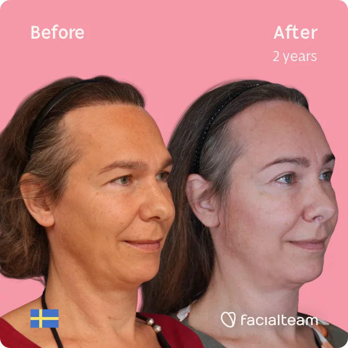 Square 45 degree image of FFS patient Mia showing the results before and after facial feminization surgery consisting of forehead, rhinoplasty feminization surgery.
