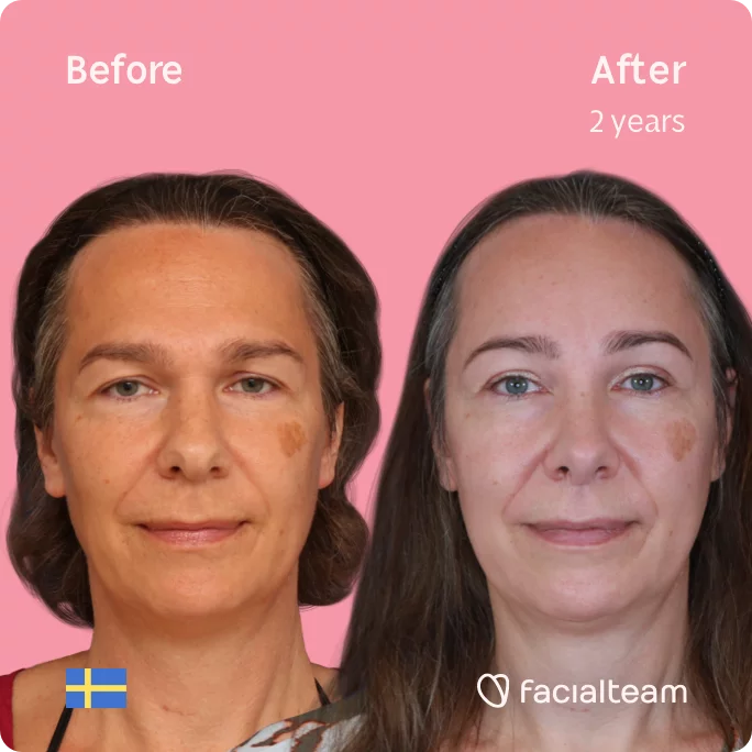 Square frontal image of FFS patient Mia showing the results before and after facial feminization surgery with Facialteam consisting of forehead, rhinoplasty feminization surgery.