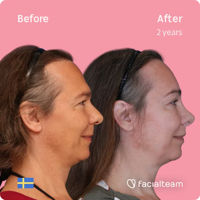 Square Side image of FFS patient Mia showing the results before and after facial feminization surgery with Facialteam consisting of forehead, rhinoplasty feminization surgery.