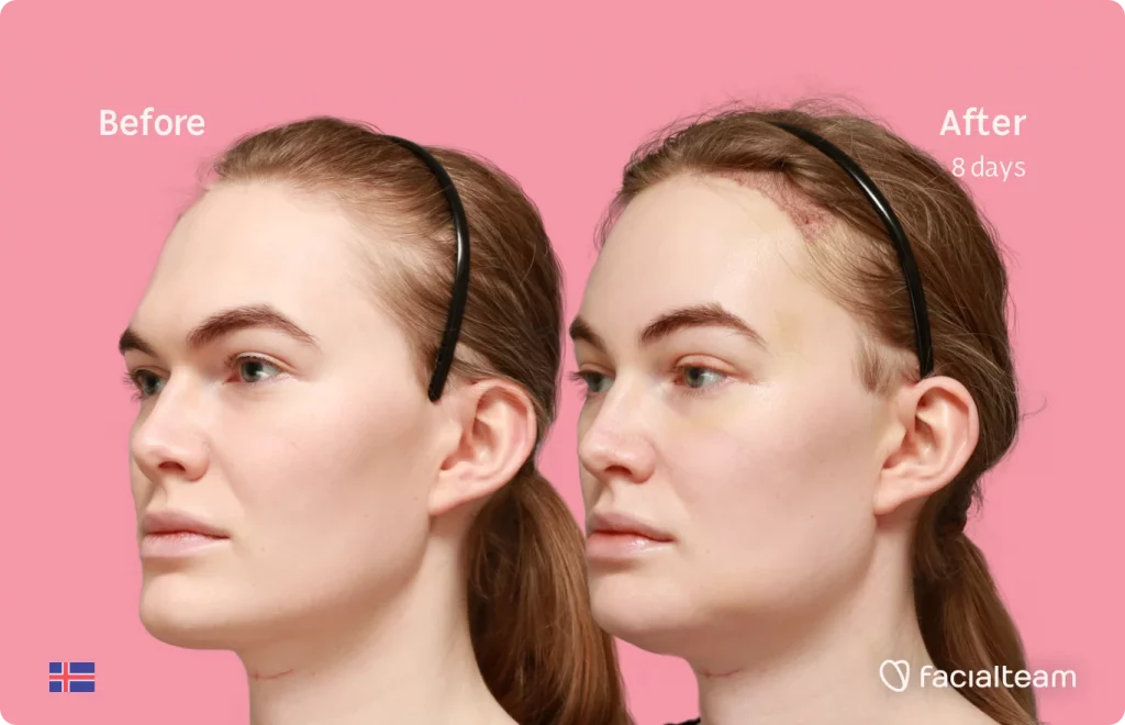 45 degree image of FFS patient Helga showing the results before and after facial feminization surgery consisting of forehead with SHT, jaw, chin, feminization surgery.