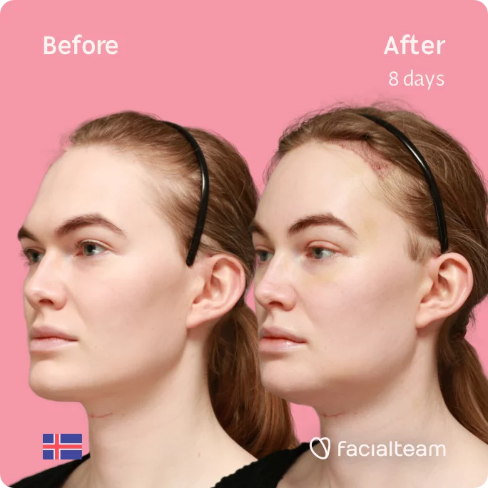 Square 45 degree image of FFS patient Helga showing the results before and after facial feminization surgery consisting of forehead with SHT, jaw, chin, feminization surgery.