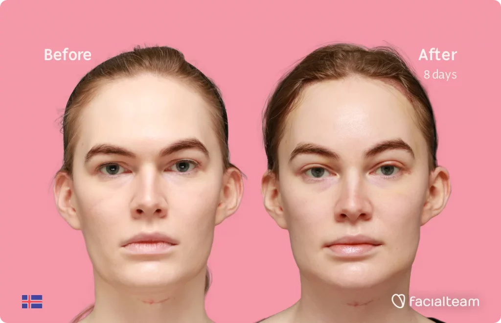 Frontal image of FFS patient Helga showing the results before and after facial feminization surgery with Facialteam consisting of forehead with SHT, jaw, chin, feminization surgery.