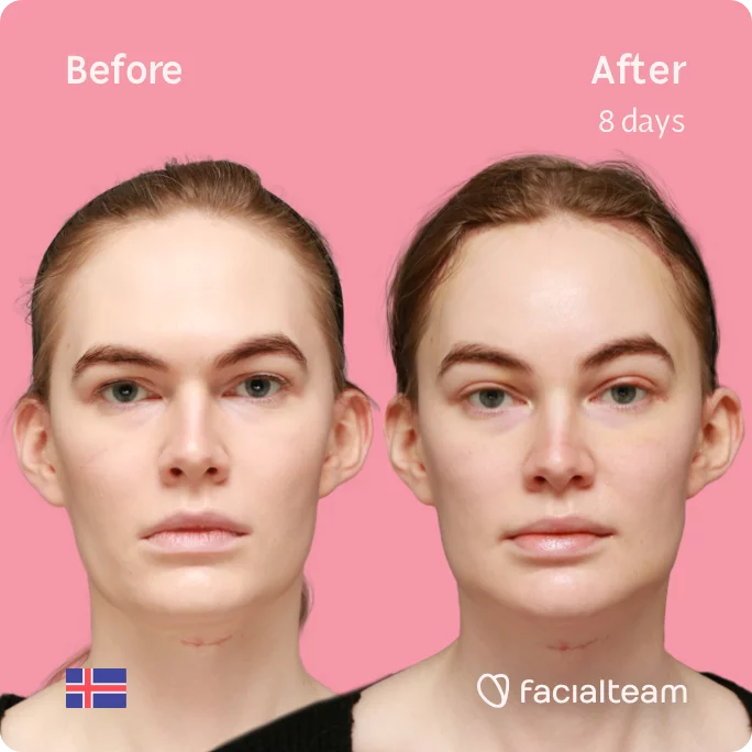 Square frontal image of FFS patient Helga showing the results before and after facial feminization surgery with Facialteam consisting of forehead with SHT, jaw, chin, feminization surgery.