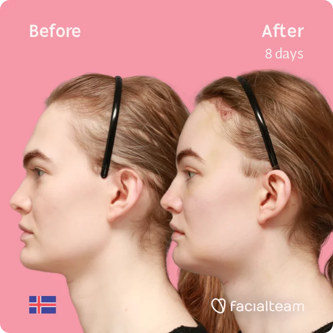 Square Side image of FFS patient Helga showing the results before and after facial feminization surgery with Facialteam consisting of forehead with SHT, jaw, chin, feminization surgery.