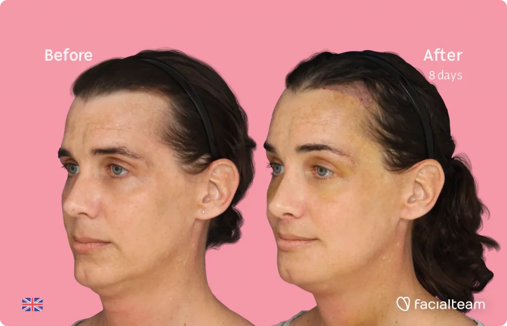 Left side 45 degree image of FFS patient Kira showing the results before and after facial feminization surgery consisting of forehead with SHT, jaw, chin, feminization surgery.