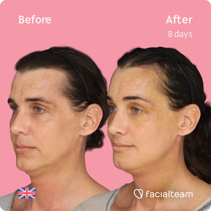 Left square 45 degree image of FFS patient Kira showing the results before and after facial feminization surgery consisting of forehead with SHT, jaw, chin, feminization surgery.