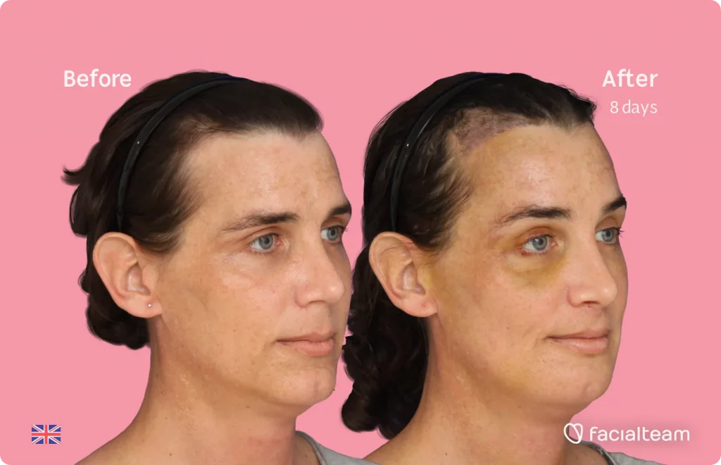 45 degree image of FFS patient Kira showing the results before and after facial feminization surgery consisting of forehead with SHT, jaw, chin, feminization surgery.