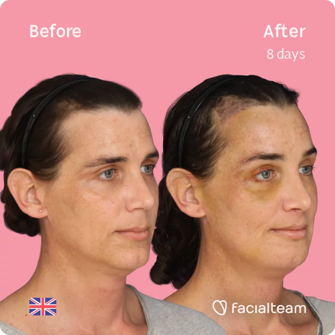 Square 45 degree image of FFS patient Kira showing the results before and after facial feminization surgery consisting of forehead with SHT, jaw, chin, feminization surgery.