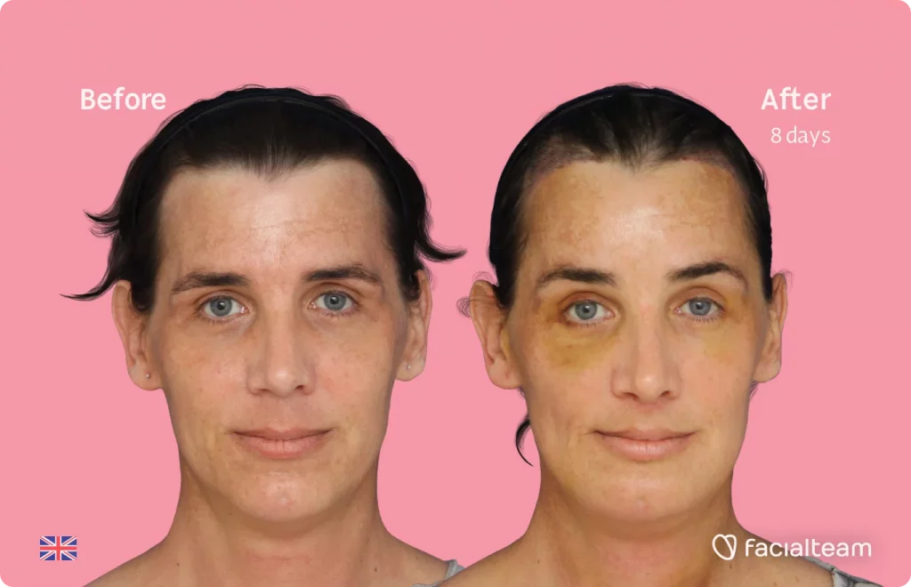 Frontal image of FFS patient Kira showing the results before and after facial feminization surgery with Facialteam consisting of forehead with SHT, jaw, chin, feminization surgery.