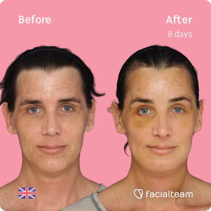 Square frontal image of FFS patient Kira showing the results before and after facial feminization surgery with Facialteam consisting of forehead with SHT, jaw, chin, feminization surgery.