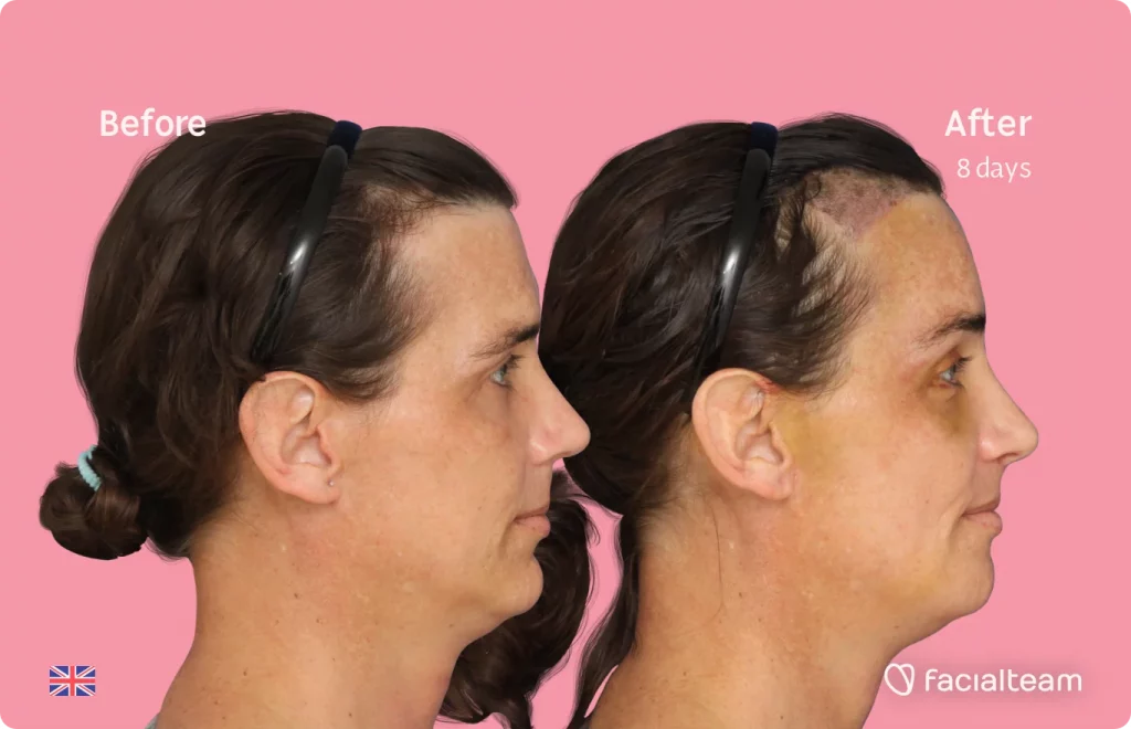 Side image of FFS patient Kira showing the results before and after facial feminization surgery with Facialteam consisting of forehead with SHT, jaw, chin, feminization surgery.