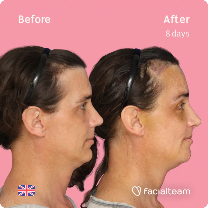 Square Side image of FFS patient Kira showing the results before and after facial feminization surgery with Facialteam consisting of forehead with SHT, jaw, chin, feminization surgery.